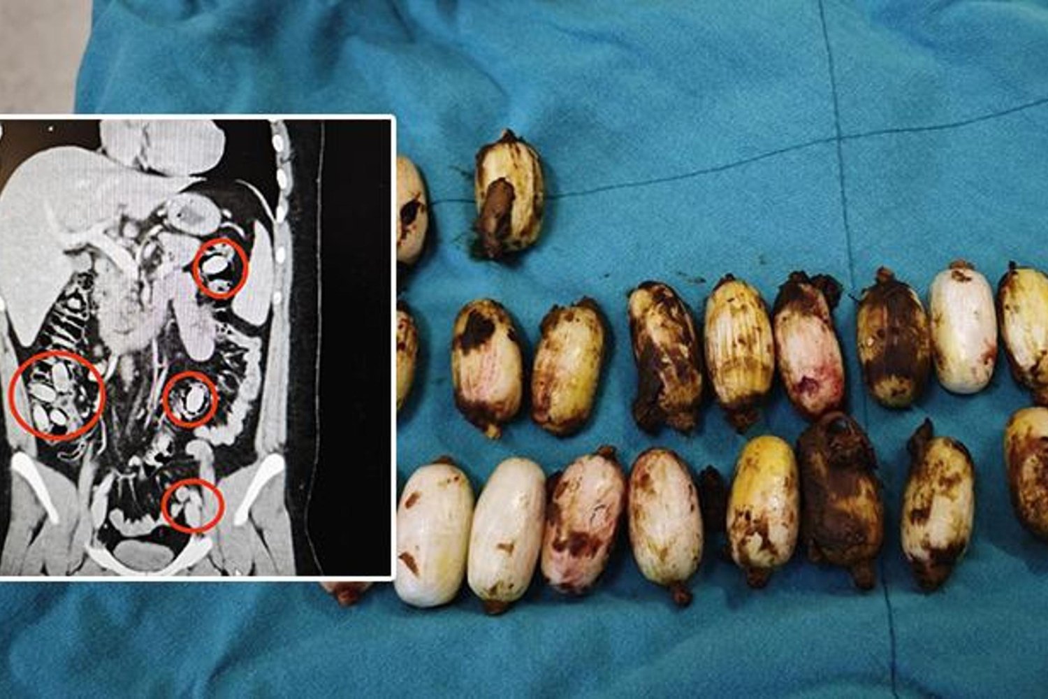 Eskişehir'de Uyuşturucu Operasyonu: Midesinde 44 Kapsül Bulunan Şüpheli Tutuklandı