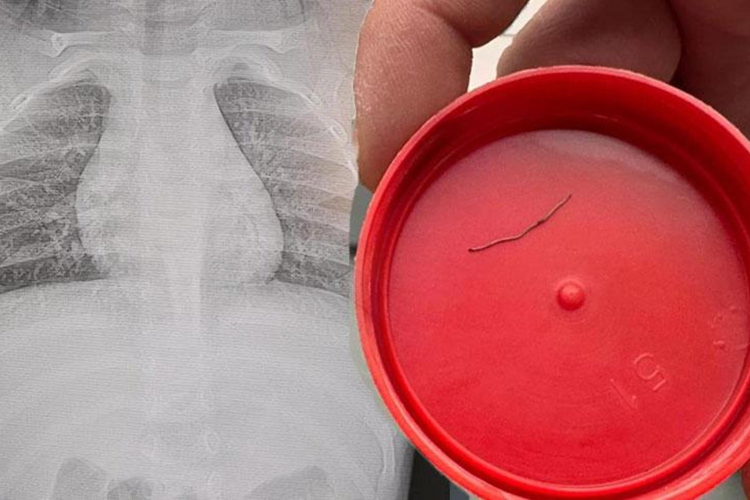 Kahramanmaraş'ta 1 Yaşındaki Bebeğin Sırtındaki Metal Cisim Ameliyatla Alındı