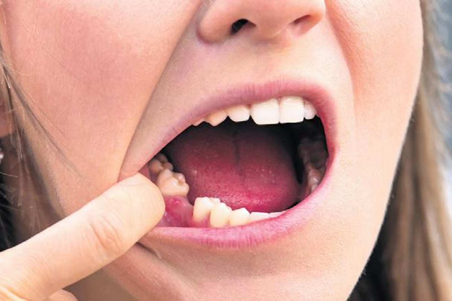 Sağlıklı Dişlerin Ömrü Uzatmada Kritik Rolü/