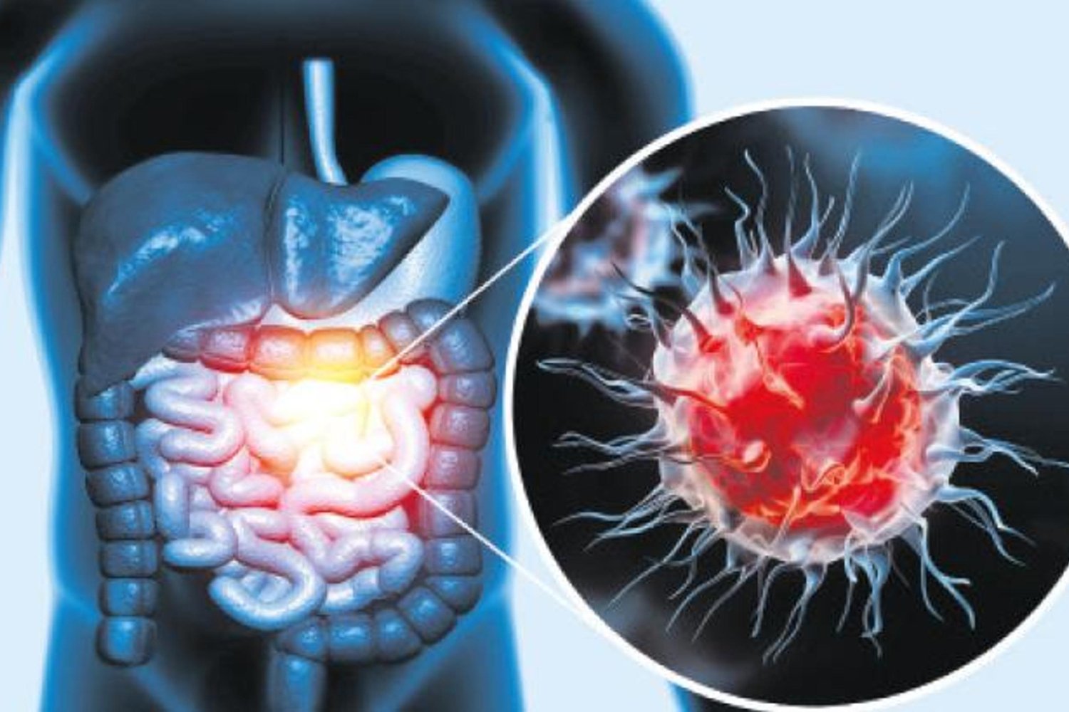 50 Yaş Altındaki Kolon Kanseri Artışında Burada Çözüm Var