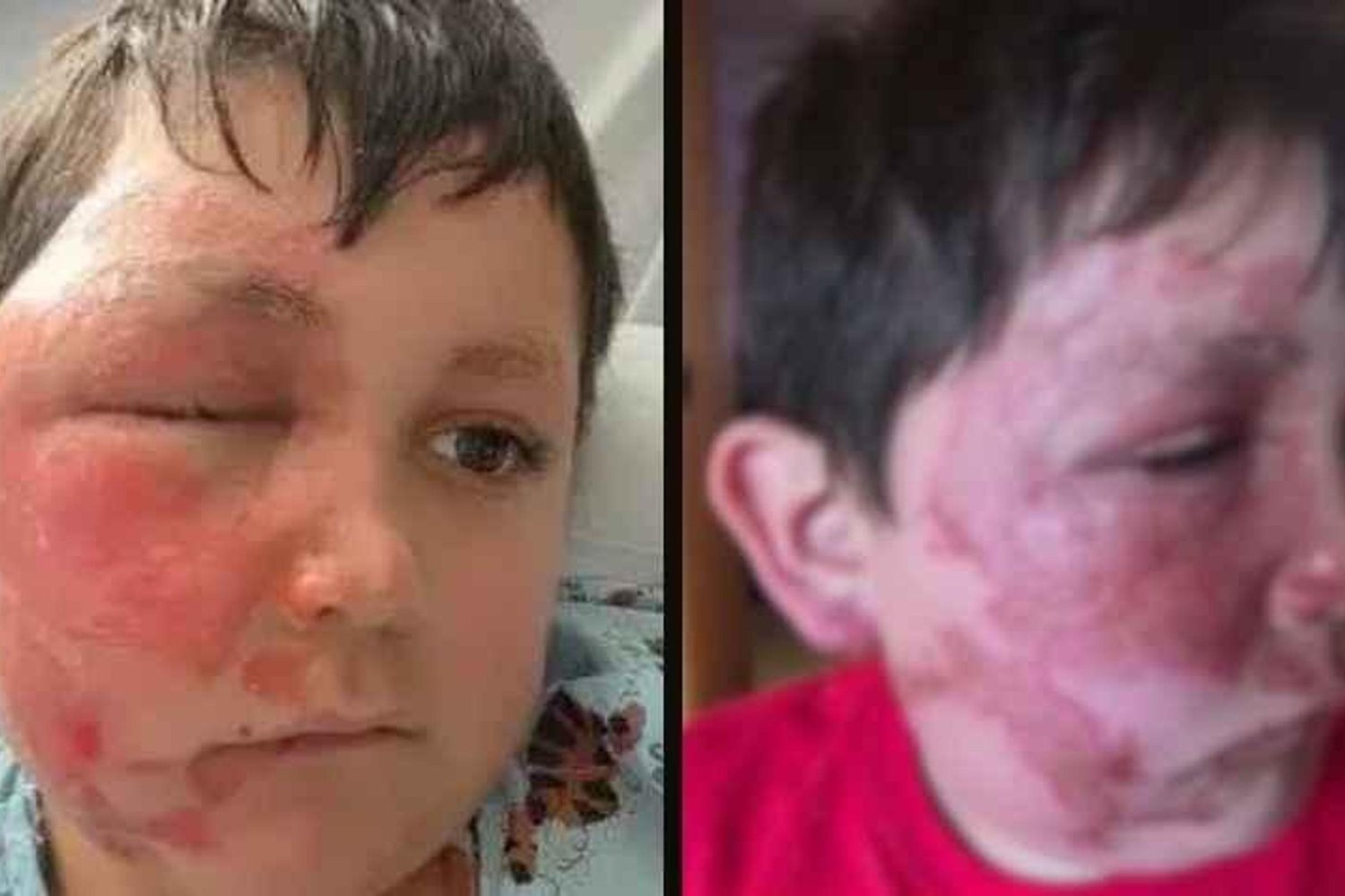 Tehlikeli Sosyal Medya Akımı: Çocuklar Mikrodalga ile Oyun Oynarken Yanıklar Artıyor