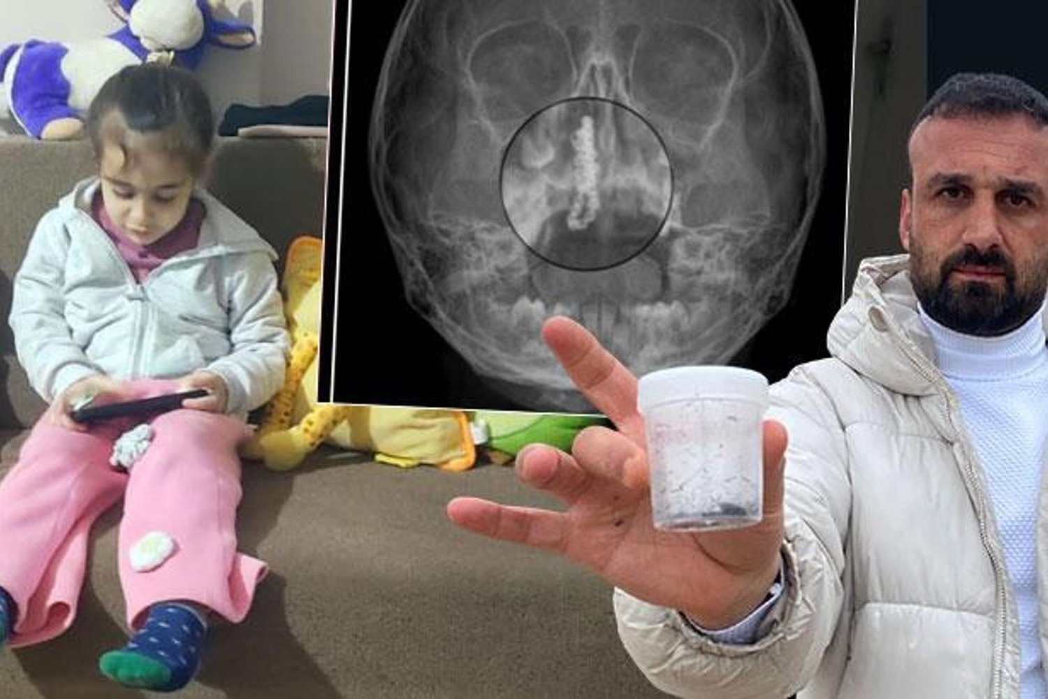 Küçük Polen'in Burnundaki Metal Zincir Şoku: Sağlığına Kavuştu, Yetkililerden İhmal Uyarısı