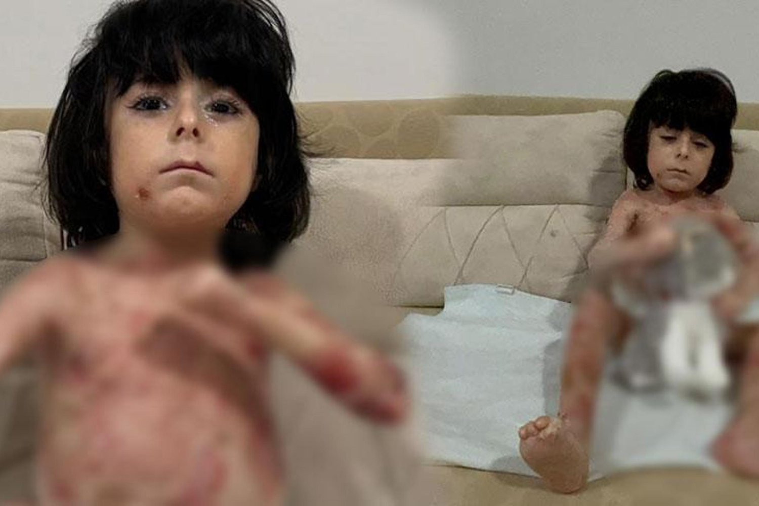 Ege'de Kelebek Hastası Çocuk İçin Yardım Çağrısı Sonuç Bekliyor