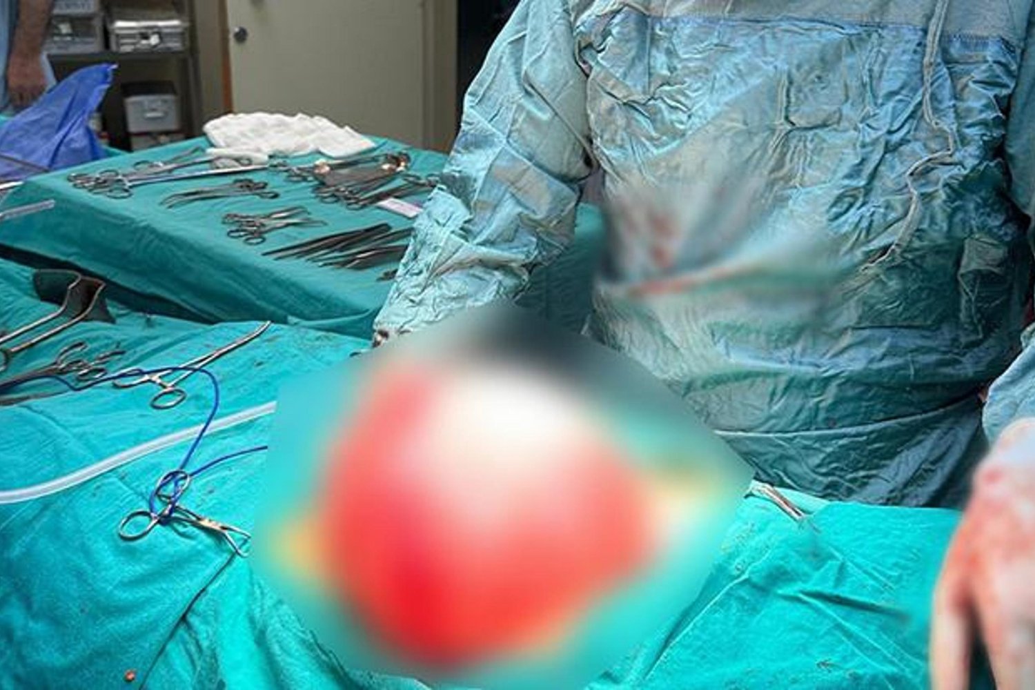 Bolu'da 14 Yaşında Kızın Karnından 3,5 Kg Kist Çıkarıldı