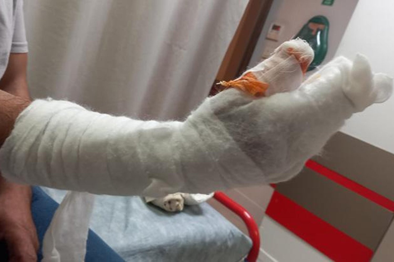 Kocaeli'nde Bayram Trajedisi: Başparmak Kesiminde İhmaller ve Amputeye Giden Süreç