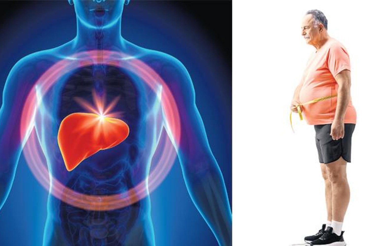 MASLD Tehlikesi Artıyor: 2050'ye Kadar 1.8 Milyar İnsan Risk Altında