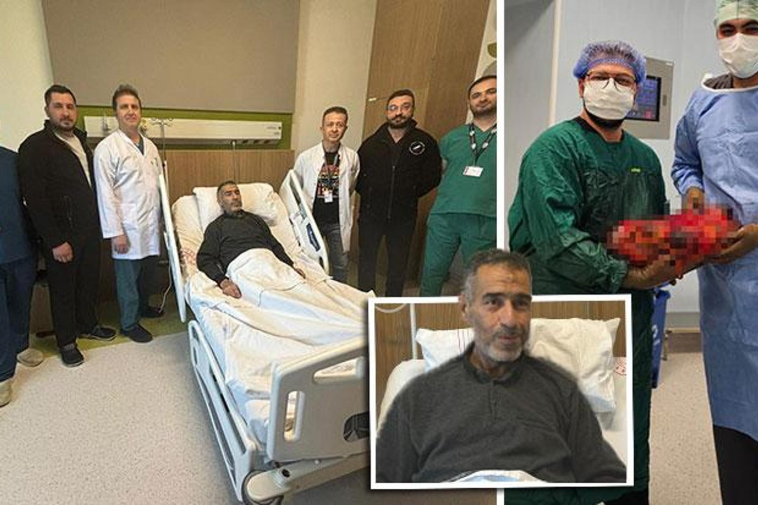 Genetik Polikistik Böbrek Hastalığıyla Mücadelede Büyük Operasyon: 50 cm Büyüklüğündeki Böbrek Alındı