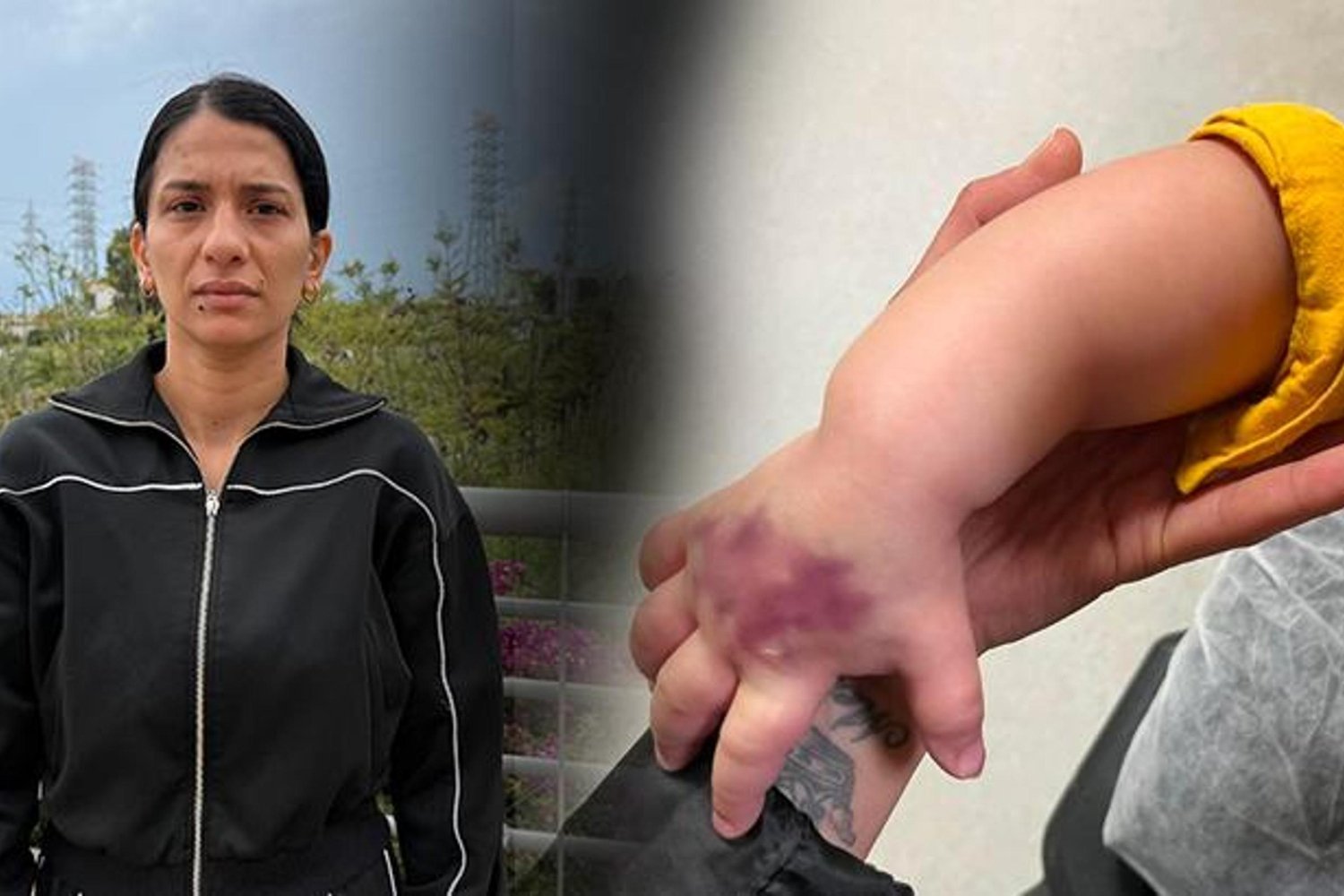 Çukurova'da Olay: Çocuk İlaçlı Tomografi Sonrası Şişlik ve Morarma Şok Yarattı