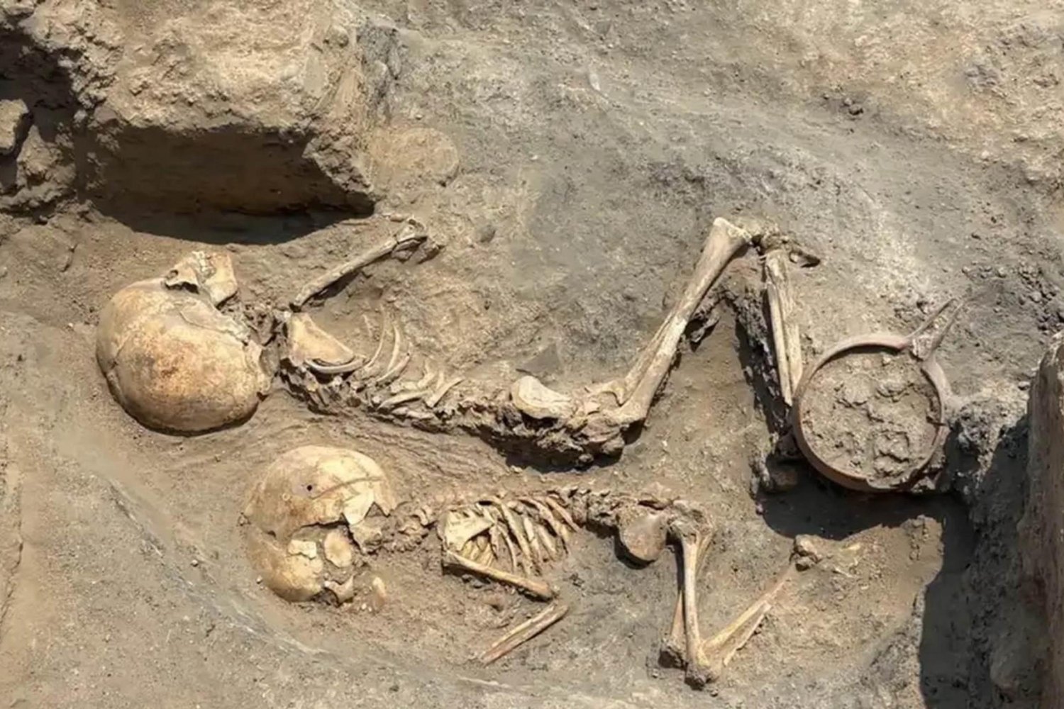 Orta Asya'da En Eski Cerrahi Müdahale: 5 Yaşındaki Çocukta Trepanasyon Keşfi
